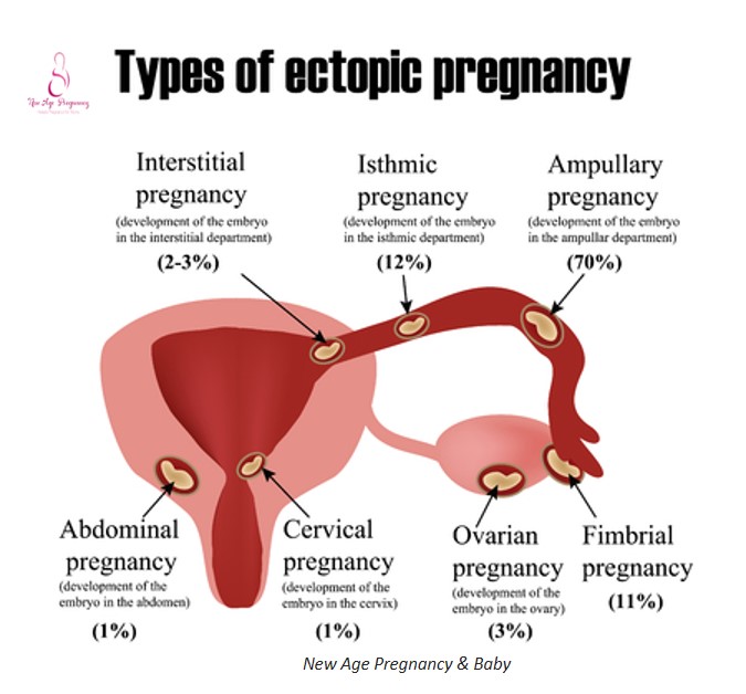 Ectopic Pregnancy The Embryo In The Fallopian Tube Infographics My