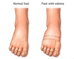 swollen foot during pregnancy