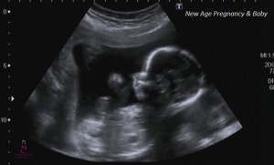 baby ultra-scan picture