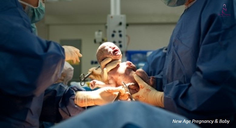 real life mother's story - cesarean