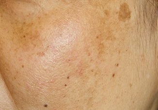 melasma-pigmentation